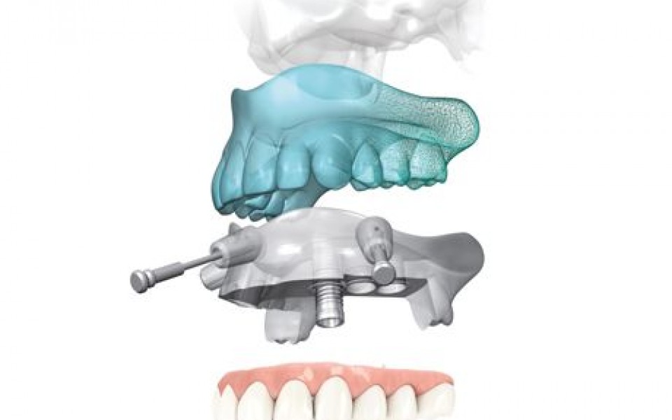 implantologia-computer-guidata-Studio-Odontoiatrico-Emiliani-Roma-Frosinone