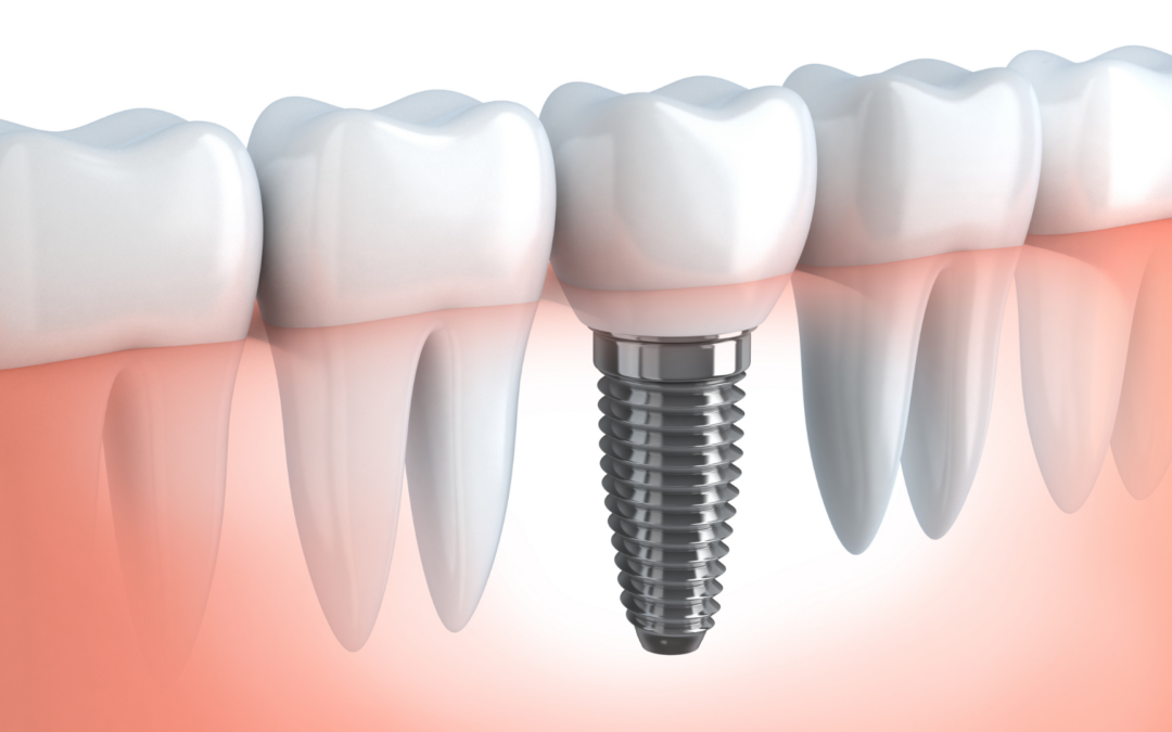 Implantologia dentale: come si esegue e quali sono i vantaggi della tecnica computer guidata