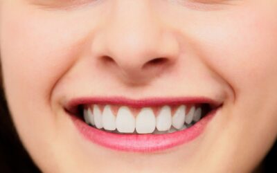 Faccette dentali: informazioni utili e vantaggi