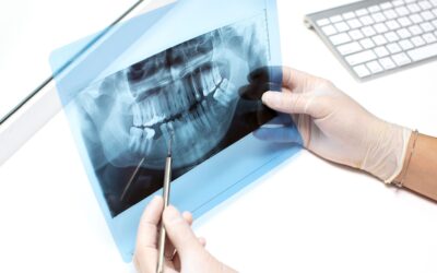 Tumore del cavo orale: l’importanza dell’odontoiatria per una diagnosi precoce