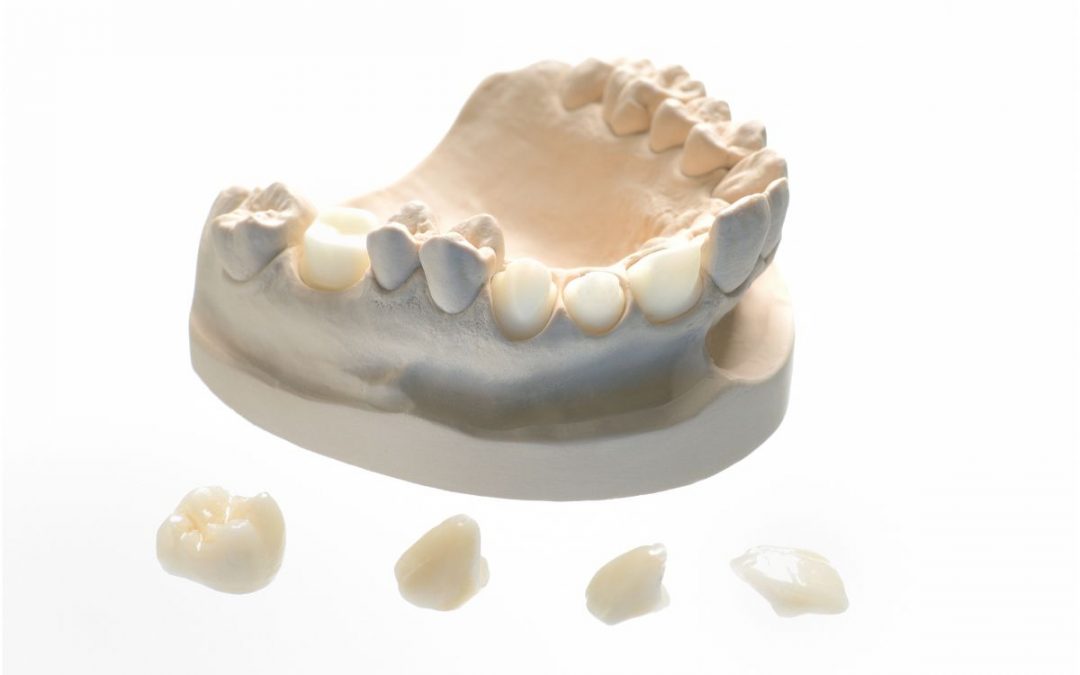 Affollamento dentale grave: cause e trattamento
