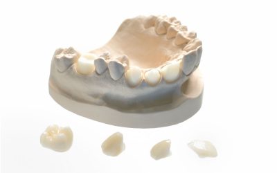Affollamento dentale grave: cause e trattamento