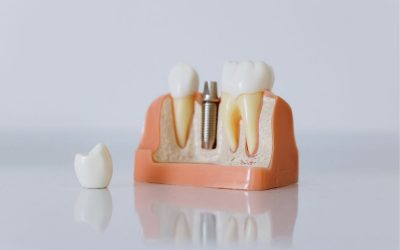 Impianto dentale fallito: cause e sintomi