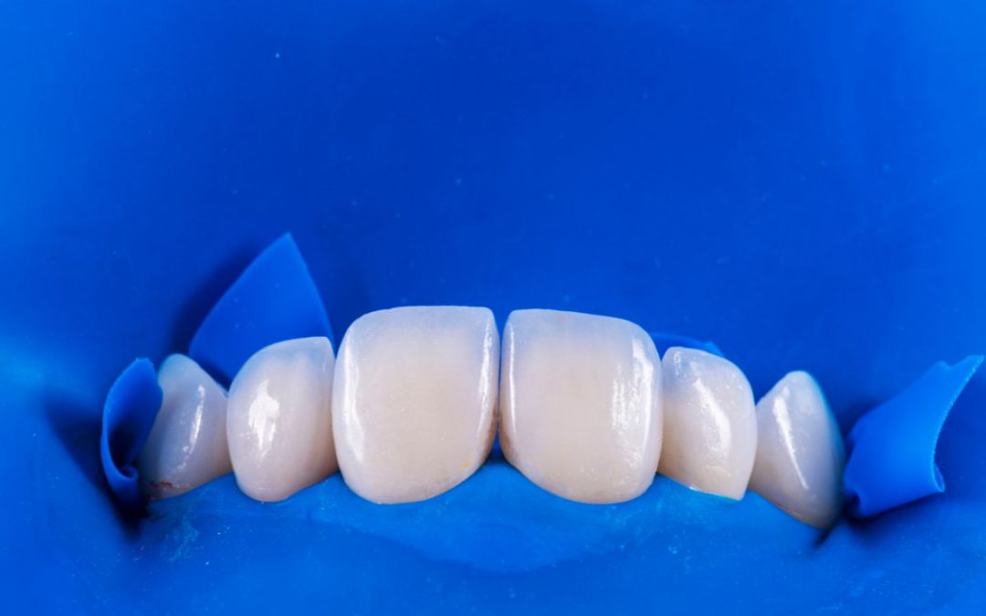 Faccette dentali per i denti storti: quando sono una valida soluzione?